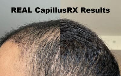 No BS – Real Capillus 312 Results Will Make You a Believer!