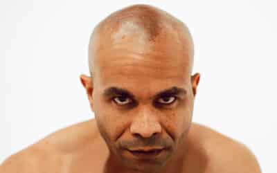 Can Capillus Stop African American Hair Loss?