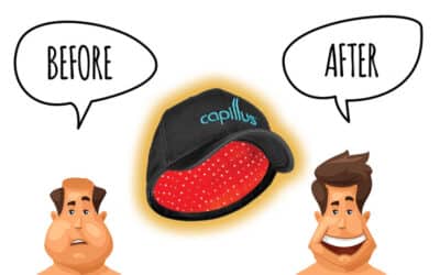 What Are Some Common LLLT Capillus Before and After Expectations?