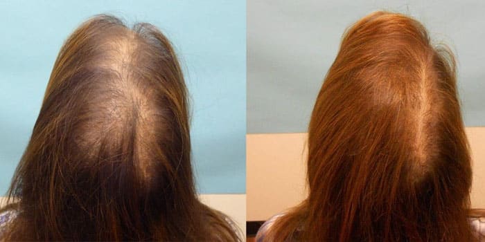 Capillus before and after lasercap results images